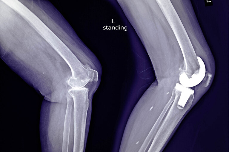 Improving the ergonomics of hand-held tools with medical robots case study